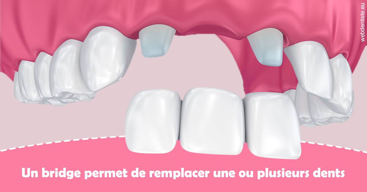 https://selarl-druet-philippe.chirurgiens-dentistes.fr/Bridge remplacer dents 2
