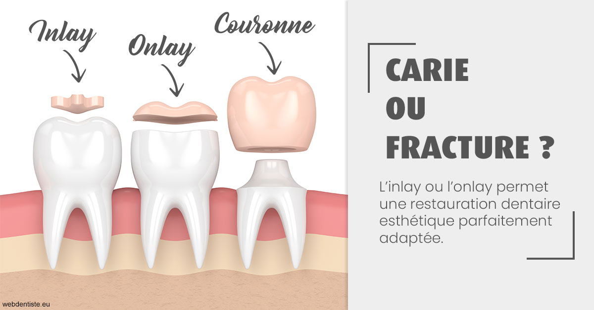https://selarl-druet-philippe.chirurgiens-dentistes.fr/T2 2023 - Carie ou fracture 1