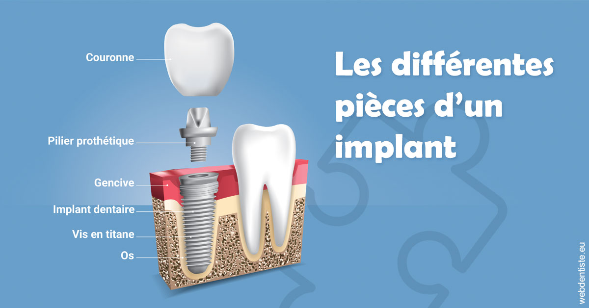 https://selarl-druet-philippe.chirurgiens-dentistes.fr/Les différentes pièces d’un implant 1